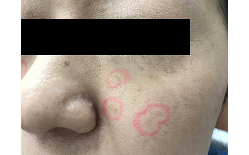 ピコスポットの症例画像before