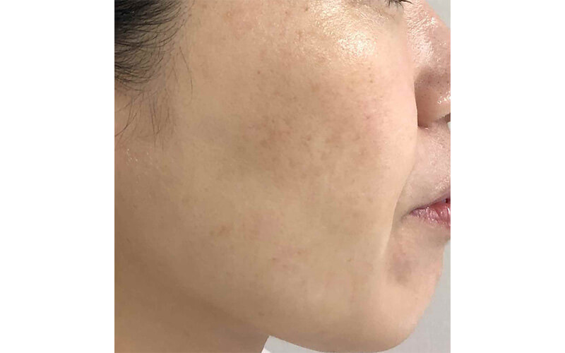 ケミカルピーリング・エレクトロポレーションの症例画像