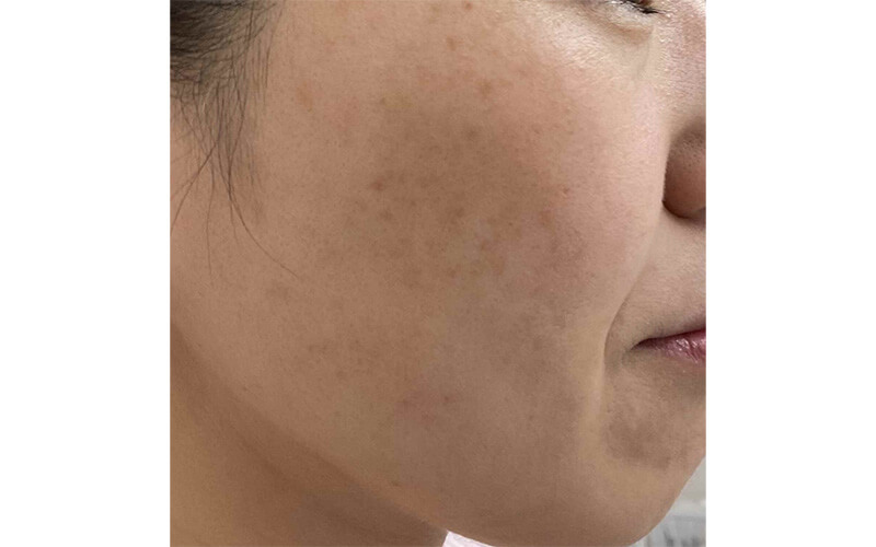 ケミカルピーリング・エレクトロポレーションの症例画像