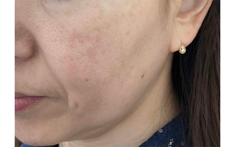 マッサージピール＋リバースピールの症例画像