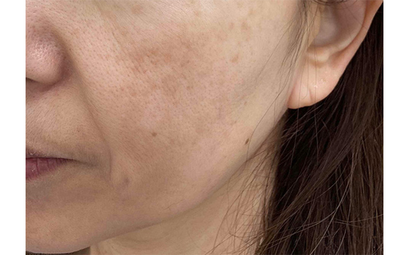 マッサージピール＋リバースピールの症例画像