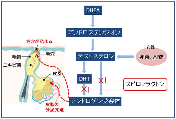 ニキビのホルモン治療